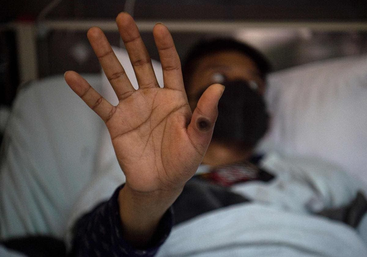 Filipinas reporta primer caso de mpox en 2024