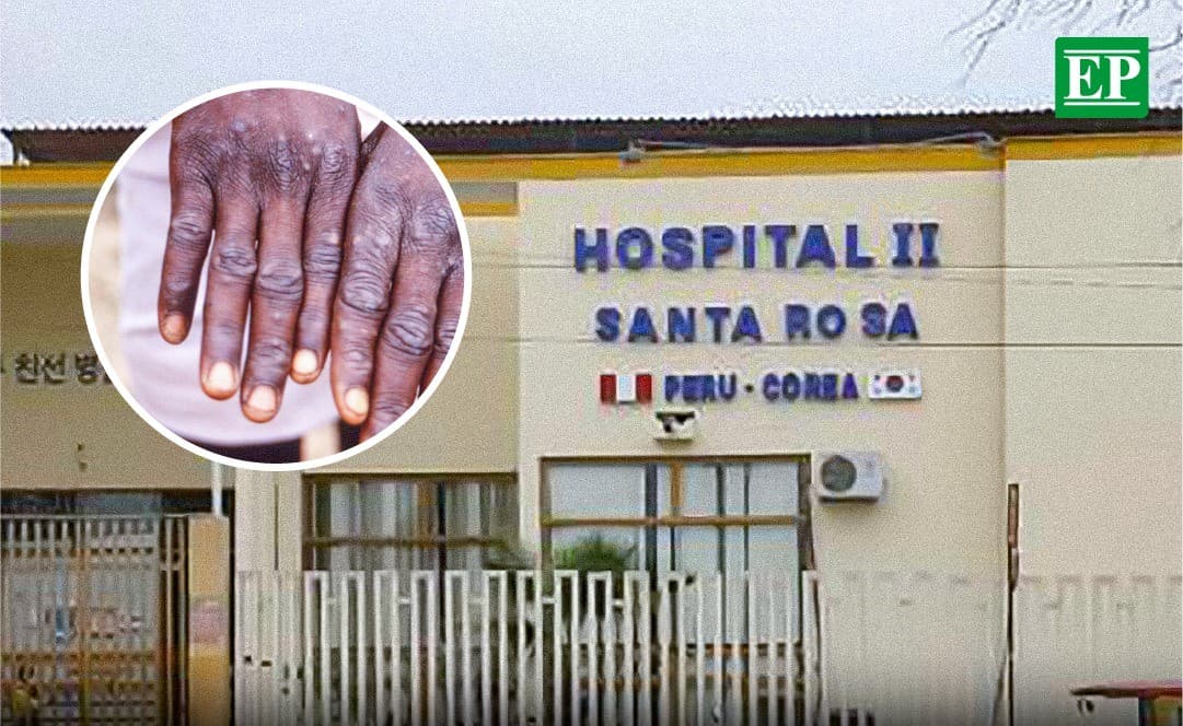 Reportan caso “sospechoso” de viruela del mono en Piura