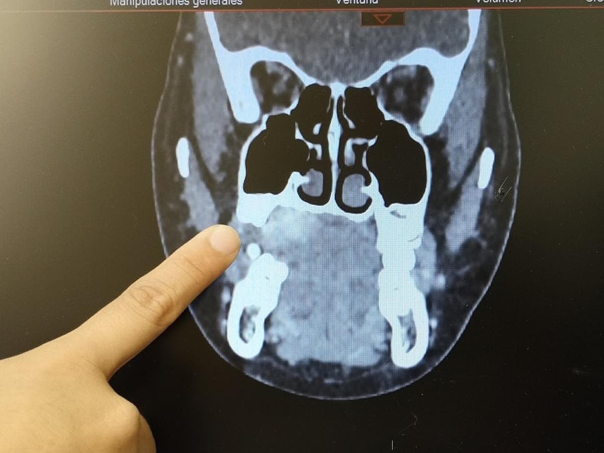 Extirparon tumor maxilofacial de menor con éxito