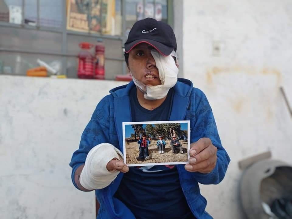 Heladero atropellado sigue con complicaciones
